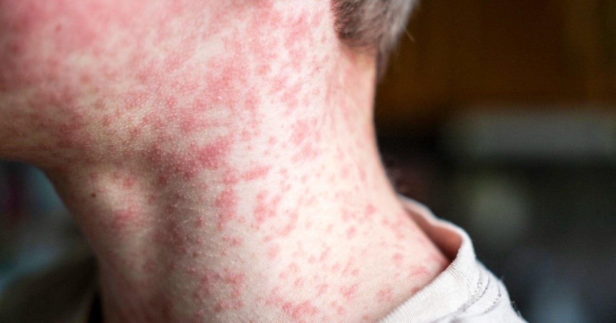 2 measles cases confirmed in Cook County: 1 in Chicago, 1 in suburbs