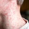 153 unvaccinated South Carolina students quarantining after measles exposure
