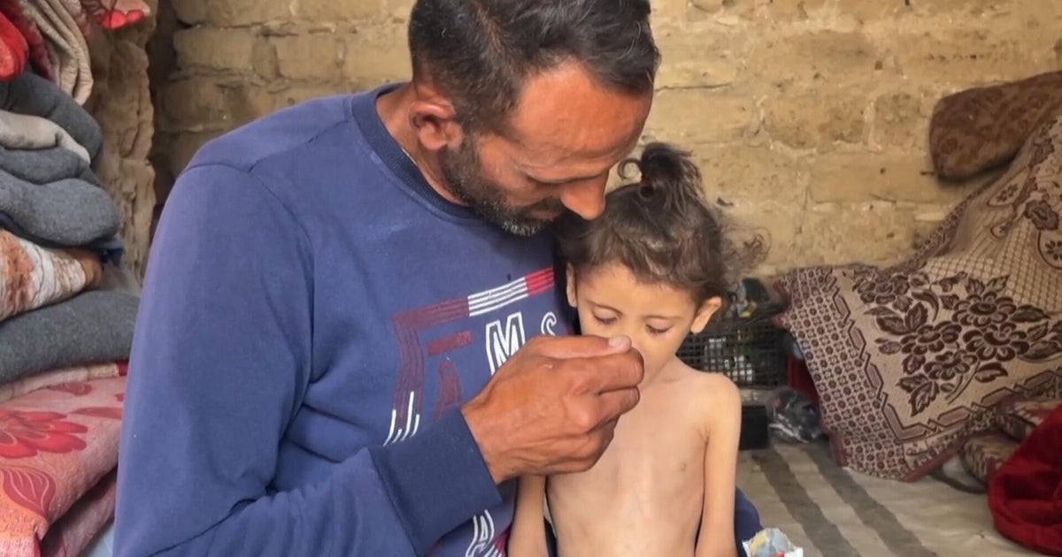 Gazze'deki 6 yaşındaki kız, büyüyen açlık krizinin ortasında sadece 13 kilo ağırlığında