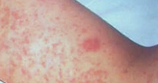 Colorado health officials: recent guests of a hotel may have been exposed to measles