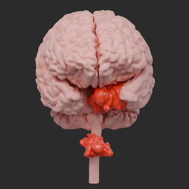 Illustration of patient two-chordomas.png 