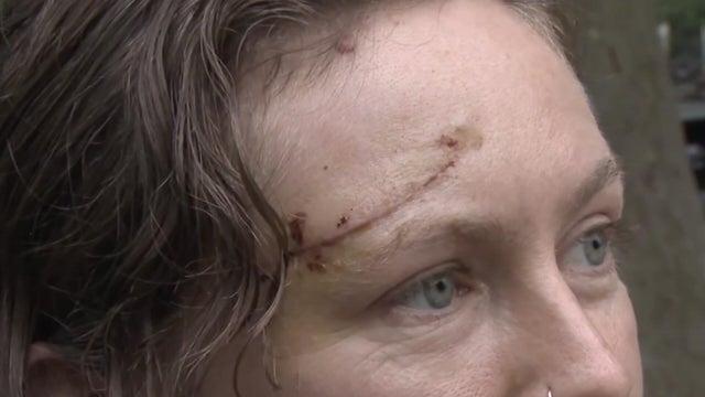 A cut on Jennifer Noble's forehead 