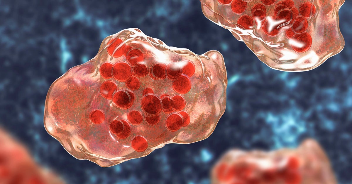 Sacramento County child being treated for measles after international trip 