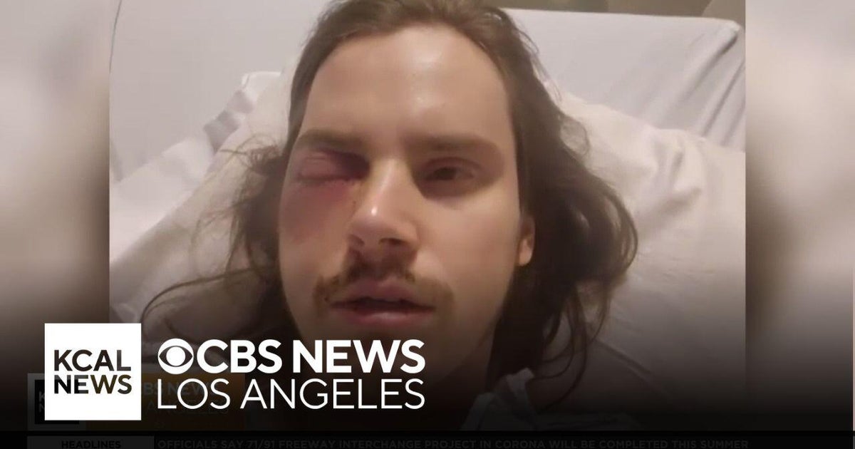 One LA protester shares his eye injury from alleged police response ...