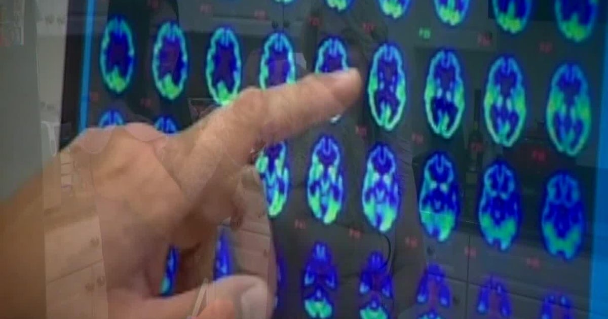 Illuminating Alzheimer’s: A Closer Look