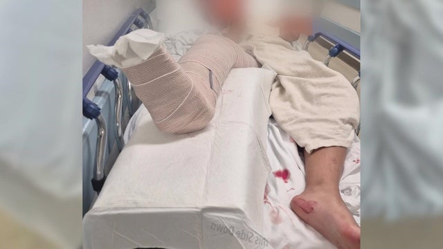 A 17-year-old girl in a hospital bed with her right leg bandaged 