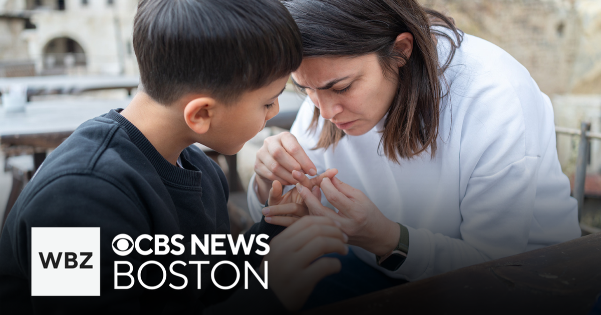 How to safely remove a splinter at home - CBS Boston