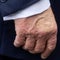 Doctor breaks down Trump's diagnosed vein condition, hand bruising