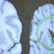 NYC shooting renews questions over CTE head trauma and violence