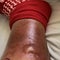 Man survives flesh-eating bacteria as warmer ocean increases risk off Florida coast
