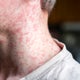 2 cases of measles confirmed in NYC, Department of Health says 