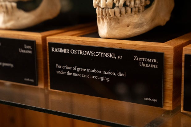 The skull of Kasimir Ostrowsczynski displayed at the Mütter Museum on Thursday, Aug. 21, 2025 
