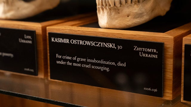 The skull of Kasimir Ostrowsczynski displayed at the Mütter Museum on Thursday, Aug. 21, 2025 