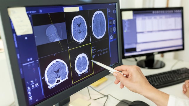 Close-up of woman doctor looking at CT scan report on computer monitor 