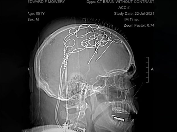 ed-mowery-brain-implants-ucsf.jpg 