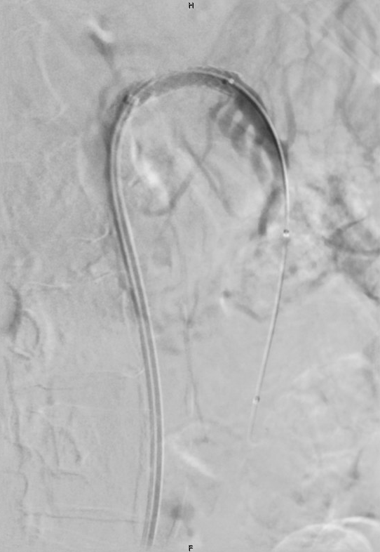 langevin-scan-3-stent-1.png
