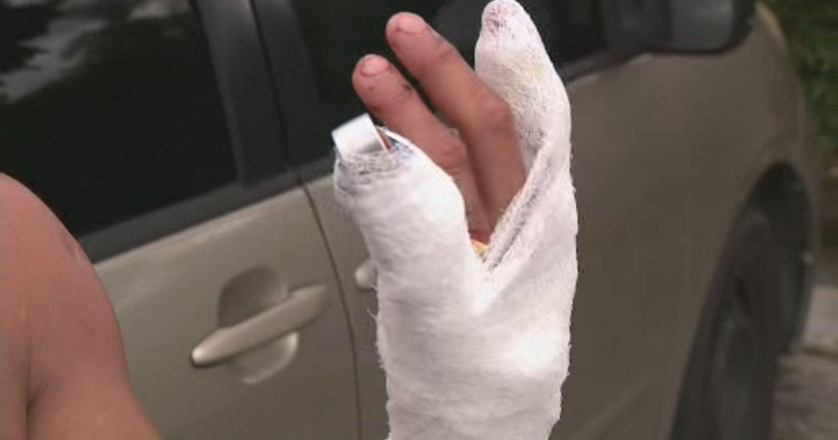 Hialeah man describes terrifying shark attack in Biscayne Bay: Hialeah man describes terrifying shark attack in Biscayne Bay: