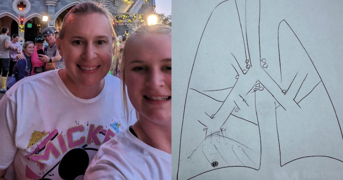 Broken limb leads to non-smoker's lung cancer diagnosis years later