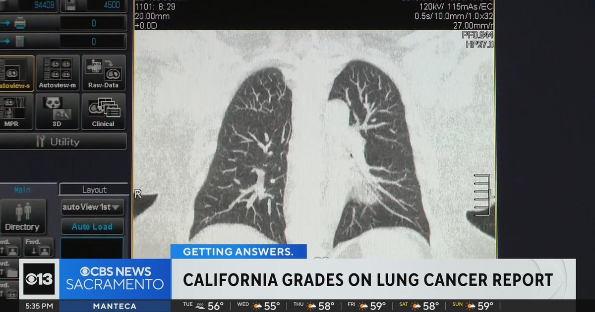 California ranks among best in nation in State of Lung Cancer report