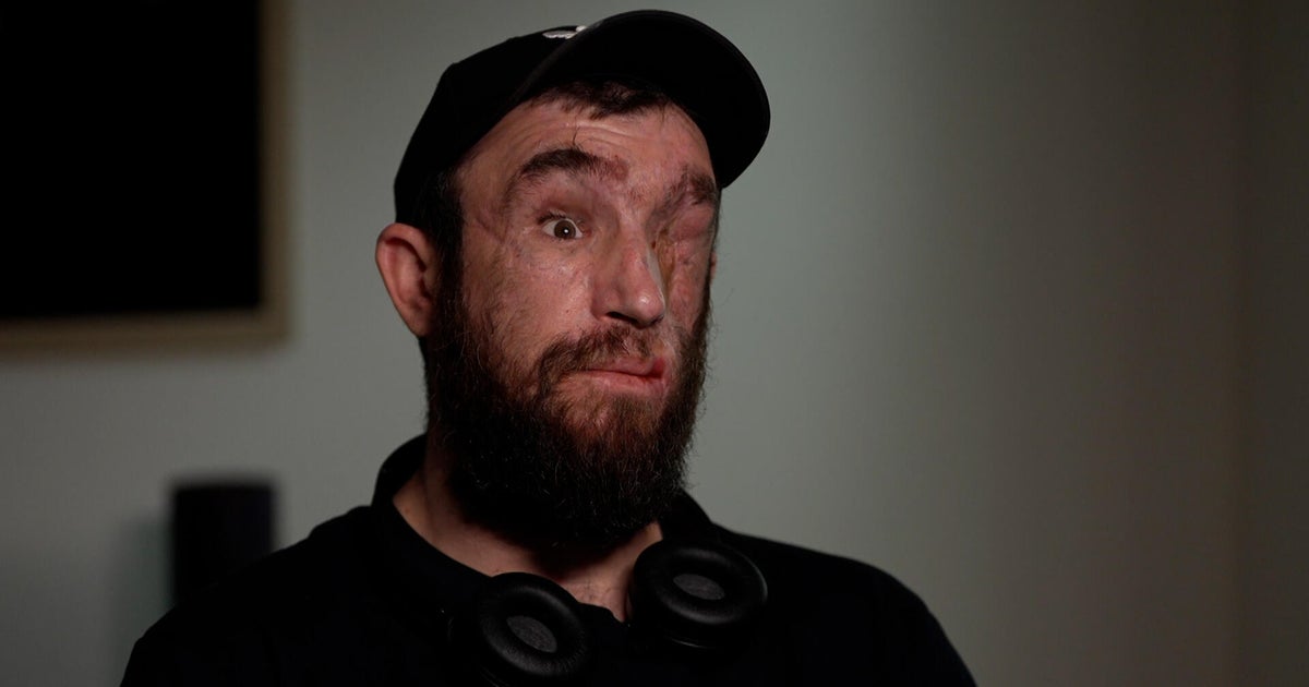 As Trump pushes Ukraine to offer Russia land for peace, a wounded soldier asks, “How far more can we give?”