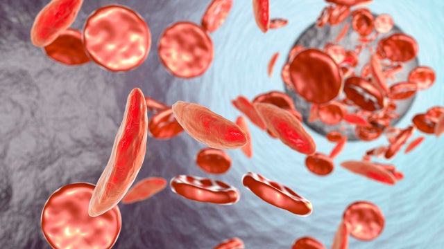 Sickle cell anaemia, illustration 