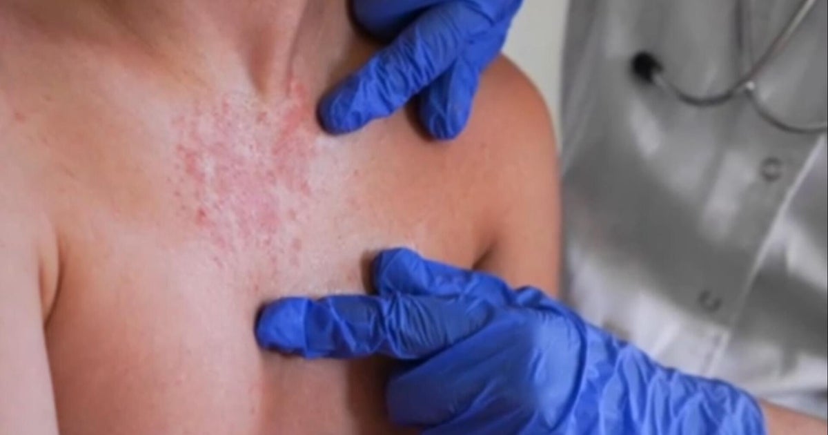 South Carolina measles outbreak now largest in U.S. since elimination over 20 years ago