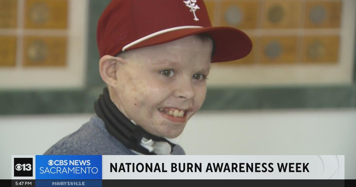 Burn survivor finds a path back to childhood at Shriners Hospital in Sacramento