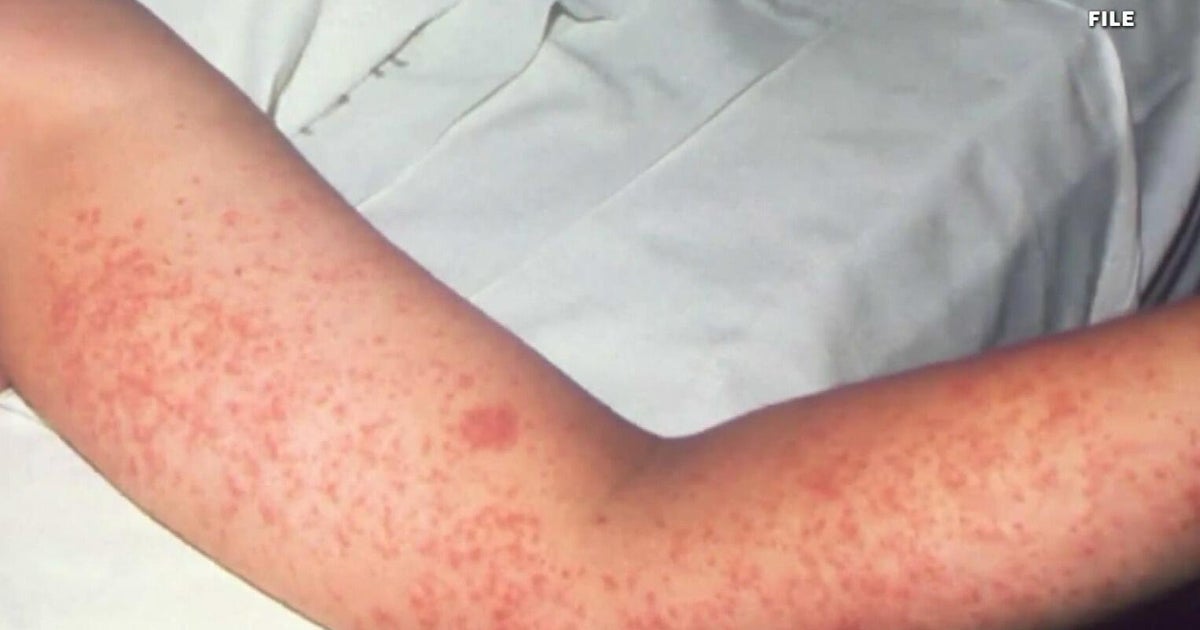 Students at Ave Maria University urged to stay home after measles outbreak