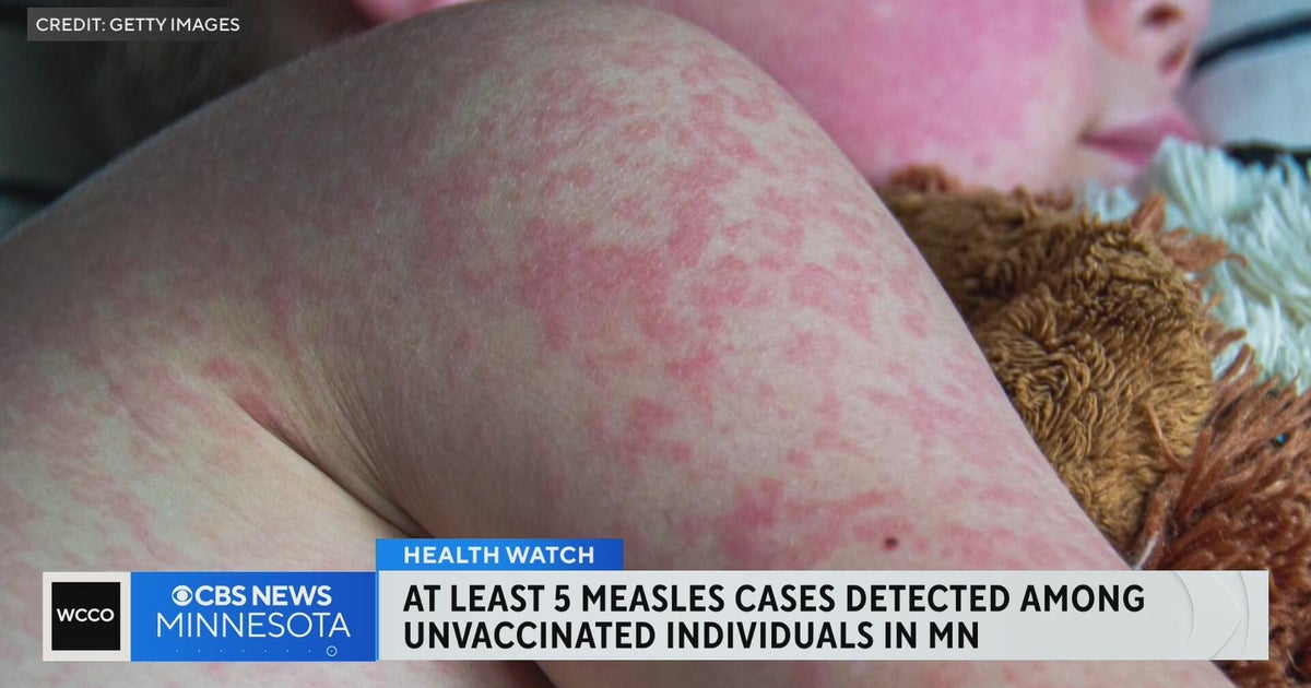 Minnesota sees 5 cases of measles so far this year