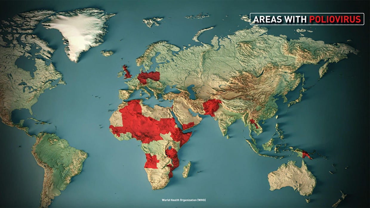 How safe is America from polio? - CBS News
