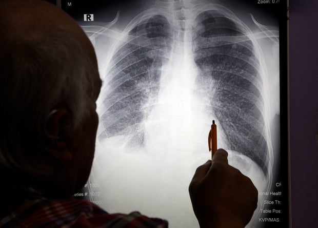 Doctor looks at an X-ray of a patient's lungs 