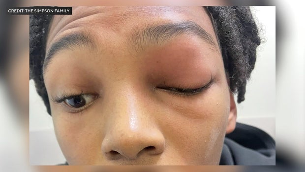 Justin Simpson's eye swollen 