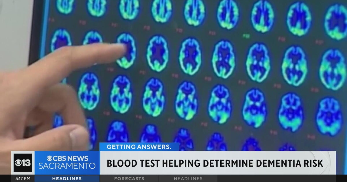 UC San Diego researcher develops blood test to help determine dementia risk in women