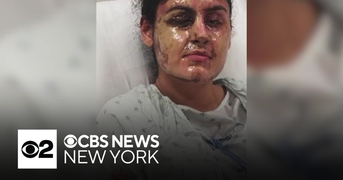 Prosecutors charged a second person in acid attack of Long Island ...