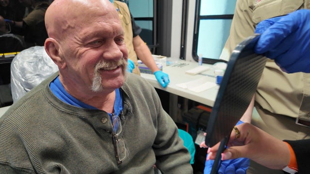 Dave Burge after getting dentures 