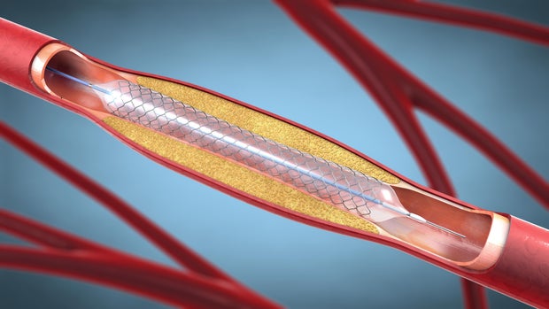 Stent implantation for supporting blood circulation into blood vessels - 3d illustration 