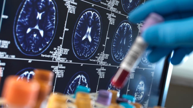 United Kingdom, High Wycombe, Alzheimer's and Dementia Research, Scientist holding a blood sample during a clinical trial with a MRI on screen 