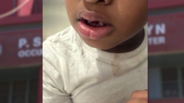 5-year-old with missing teeth and blood stain on shirt 