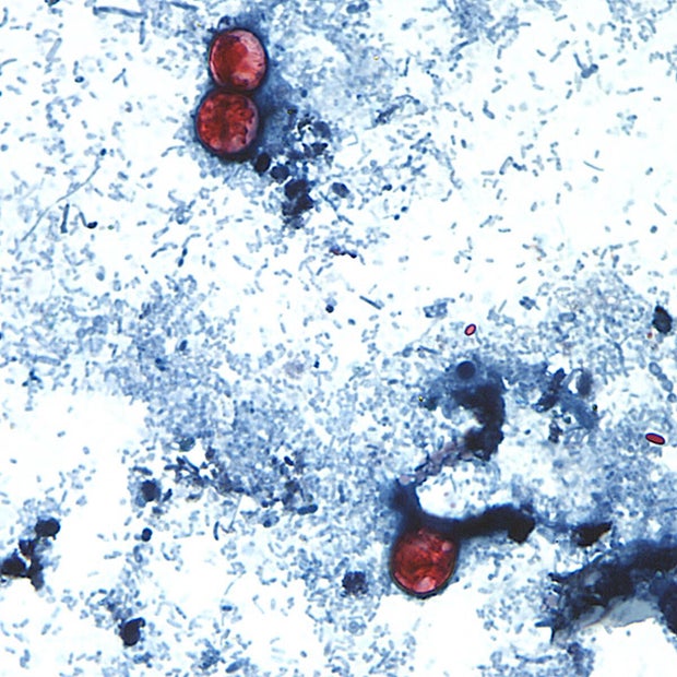 Cyclospora Outbreak 