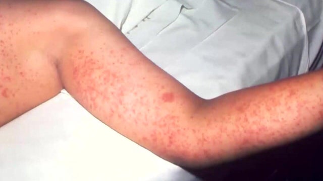 for-web-measles-ucd.jpg 