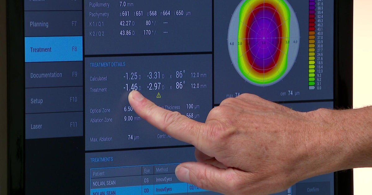 Twin Cities eye clinic becomes first in U.S. to offer WaveLight Plus LASIK