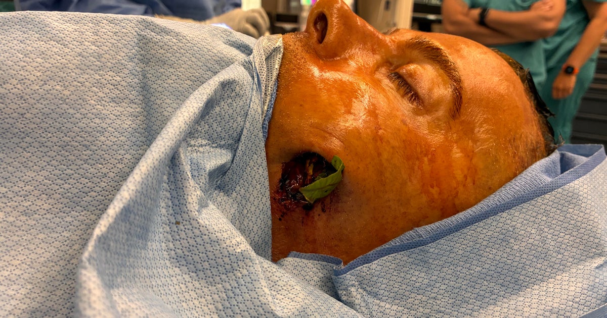 Tree branch impales South Jersey man through face and into brain in freak accident: 