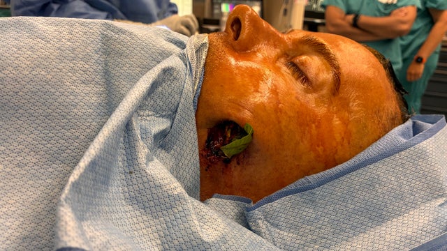 In a freak accident, a South Jersey father was impaled by a tree branch in his face when he fell from a ladder in his yard. The branch went through his nose and into his brain. 
