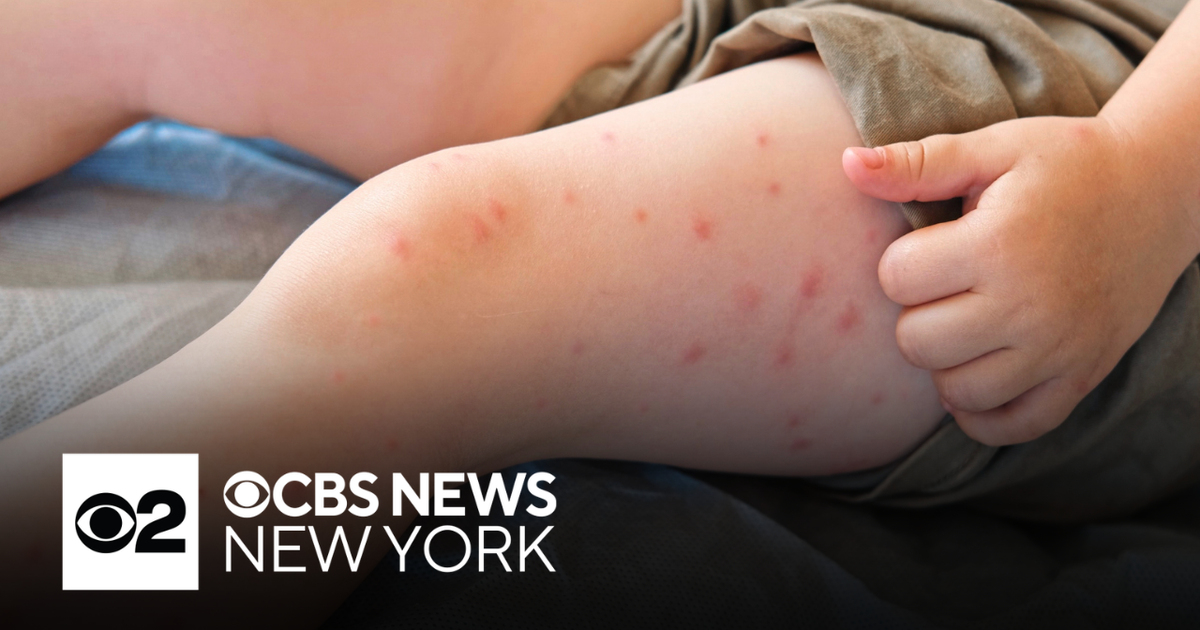 Third case of measles confirmed in Connecticut