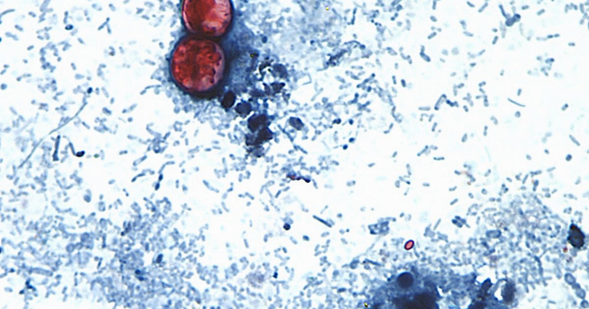 Cyclospora outbreak tied to 3 more states, FDA says