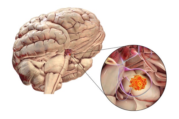 Pituitary gland tumour, illustration