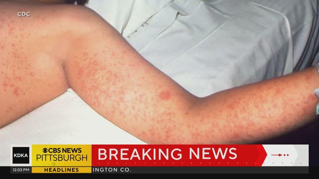 Second case of measles confirmed in Allegheny County, 11 people quarantined