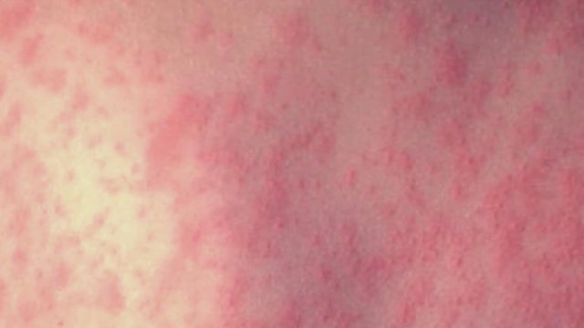 Allegheny County's 2 measles cases connected to same school