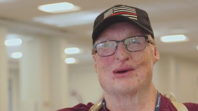 Burn survivor finds a second chance in a Georgia school cafeteria