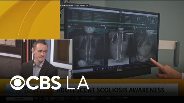 Adolescent scoliosis awareness with Dr. Tyler Tetreault